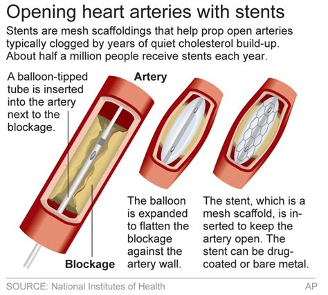 Kalp damarına stent takılması